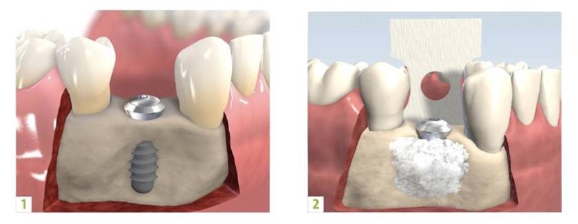 Bone Graft 2